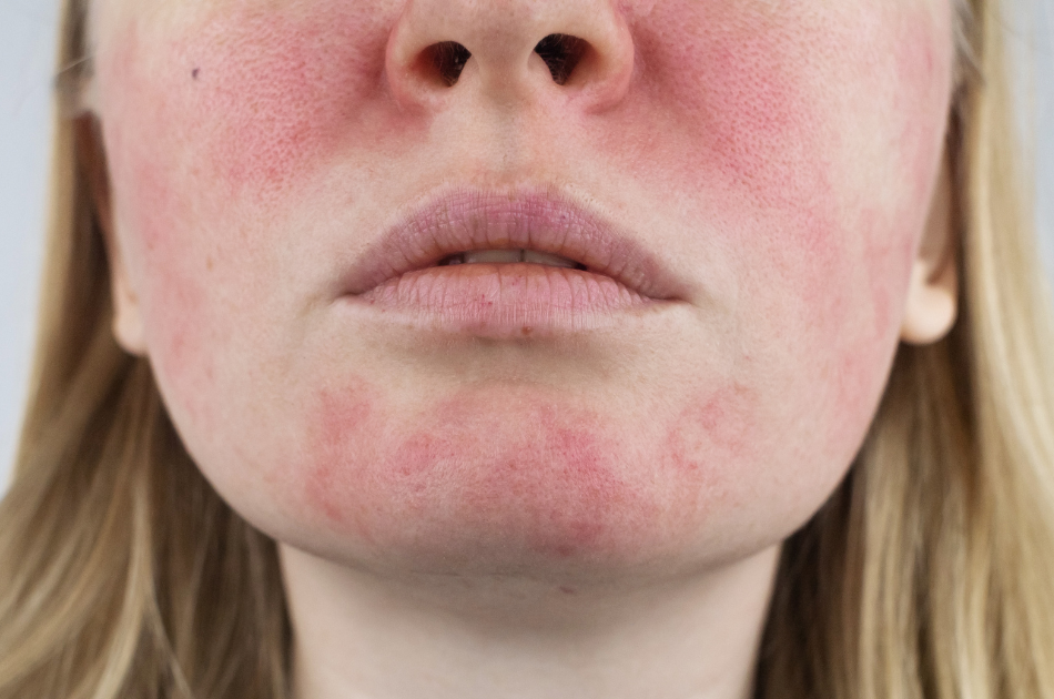 1 rosacea og rødme rosacea og rødme og kar. Behandling og viden om rosacea