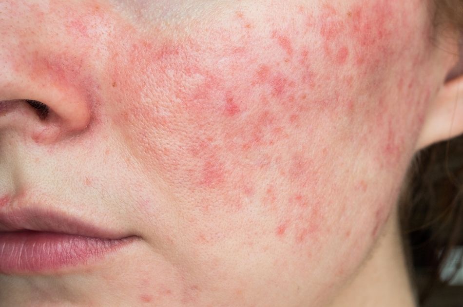 1 Rosacea Viden om rosacea. Info om behandling af rosacea. O'Skin Clinic Kolding.