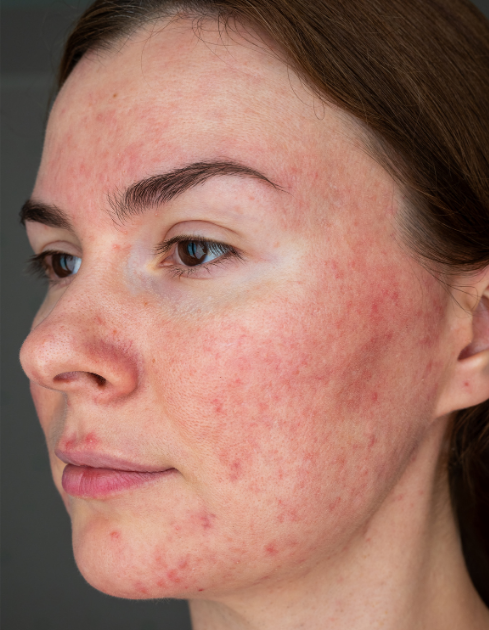 2 rosacea og rødme rosacea og rødme. Behandling og viden om rosacea. O'Skin Clinic Kolding