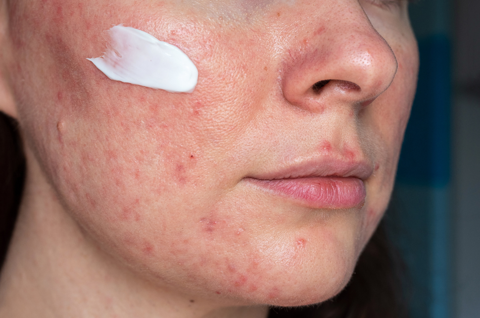 3 rosacea og rødme rosacea og rødme. Viden om rosacea. Behandling af rosacea. O'Skin Clinic Kolding