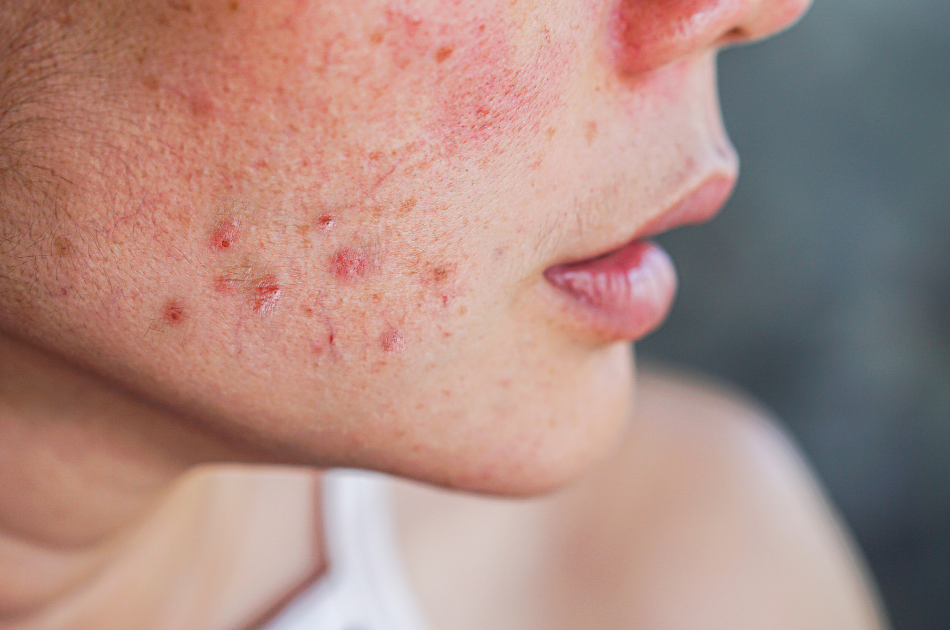 4 Rosacea og rødme rosacea og rødme. Viden om rosacea. O'Skin Clinic Kolding.