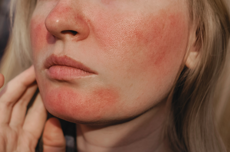 5 rosacea og rødme Rosacea og rødme. Viden om rosacea. Behandling rosacea. O'Skin Clinic