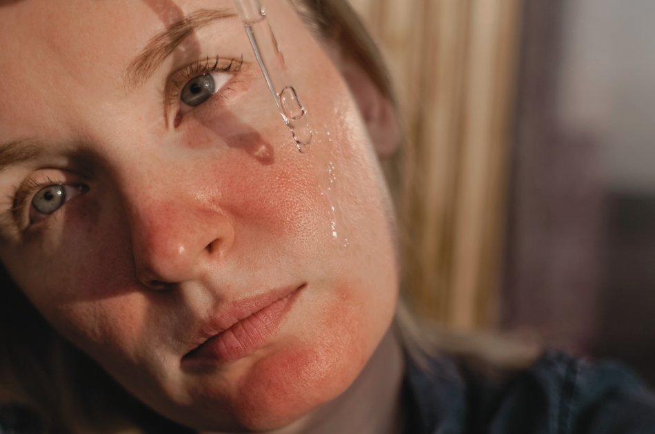 6v rosacea og rødme Rosacea og rødme. Viden og info om rosacea. Rosacea behandling. O'Skin Clinic Kolding