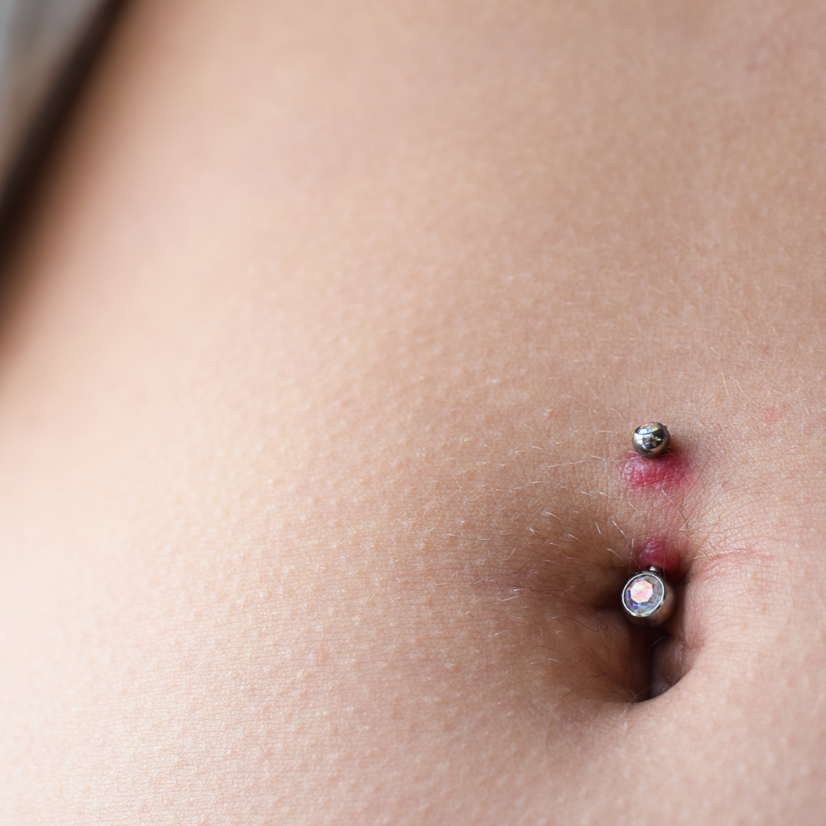 18 ar efter piercing ar efter piercinger og mindre sår. O'Skin Clinic Kolding