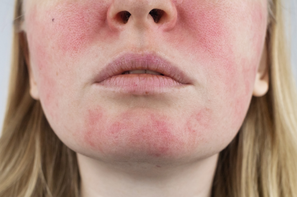 rødme og flushing I ansigtet. Rødme i ansigtet. O'Skin Clinic Kolding