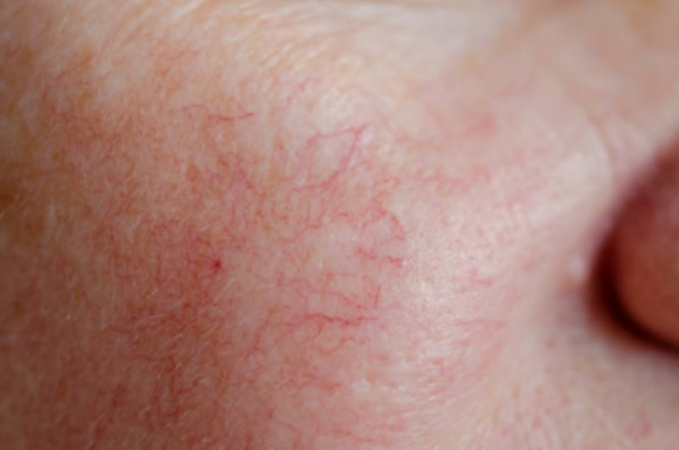 Karsprængninger i ansigtet. Behandling hos O'Skin Clinic Kolding