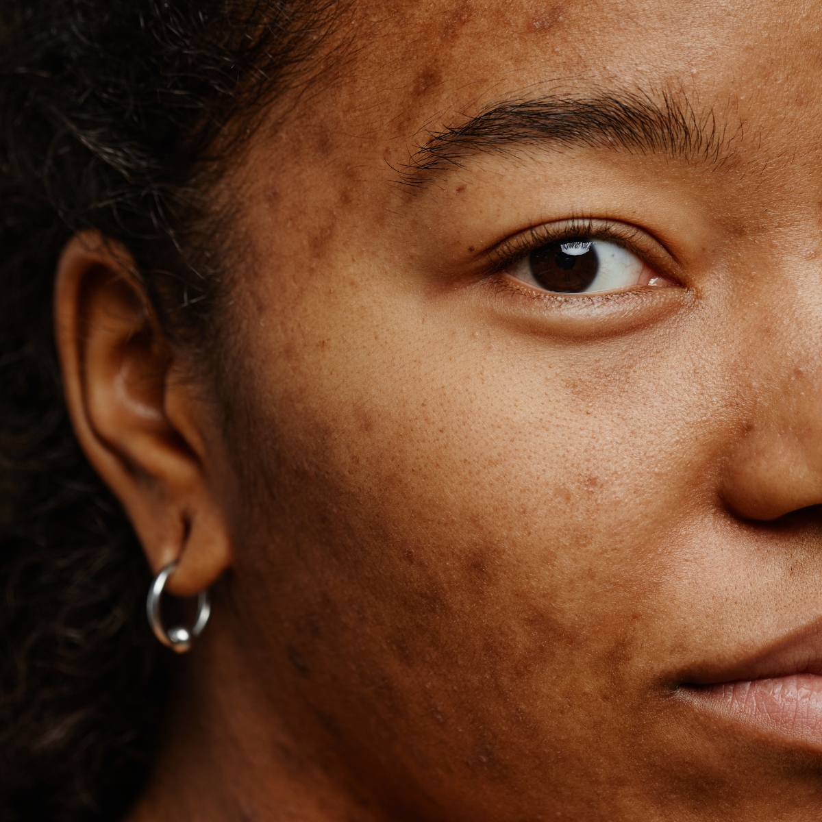 5 PIH og PIE PIE og PIH er mærker der skabes i huden som efterreaktion på en inflammatorisk tilstand. Det kan behandles hos O'Skin Clinic i Kolding