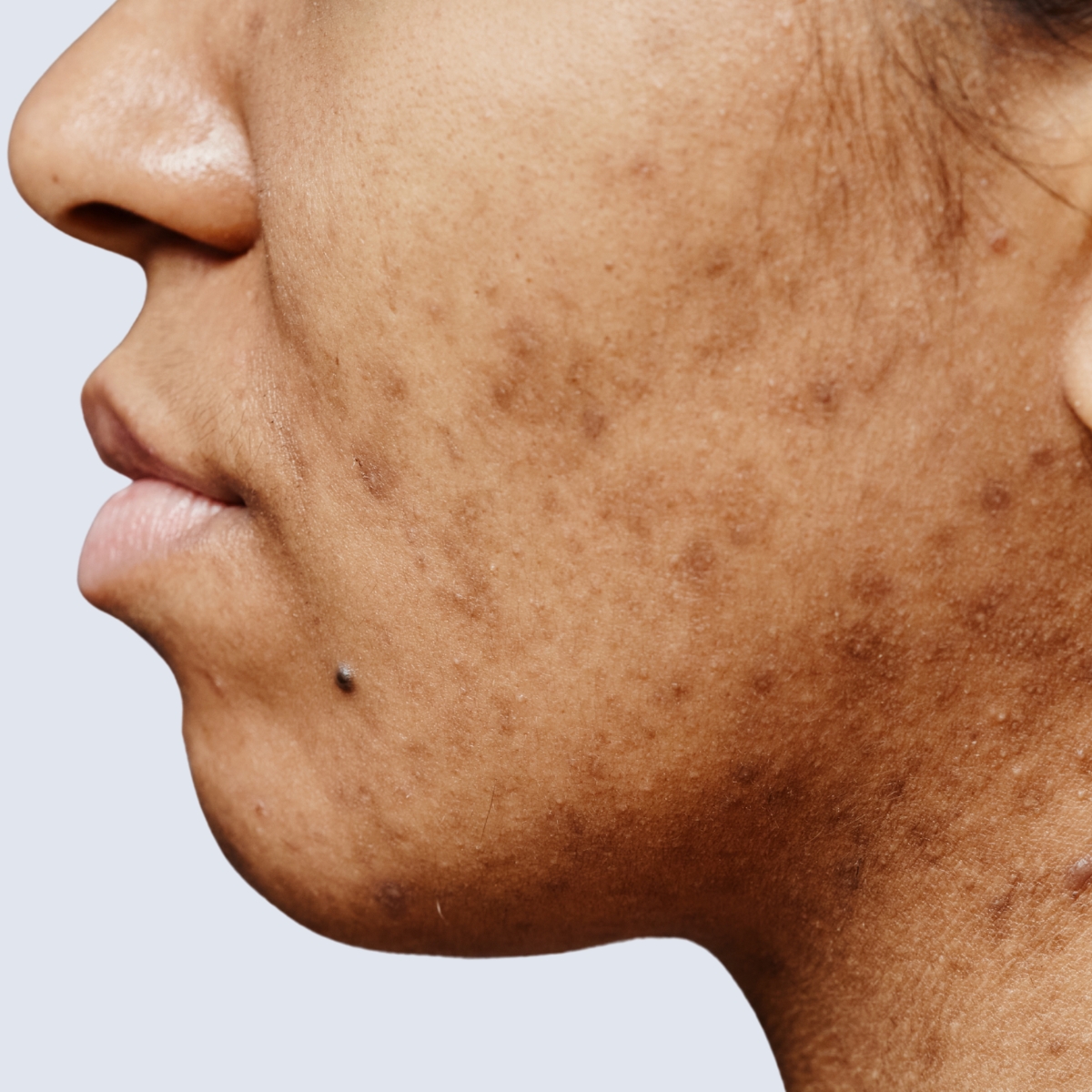 8 PIH Post inflammatory hyperpigmentation er pigmentering og mærker i huden efter inflammatoriske tilstande som f.eks. akne. Det kan behandles hos O'Skin Clinic i Kolding