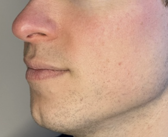 Flushing og diffus rødme. Behandling hos O'Skin Clinic