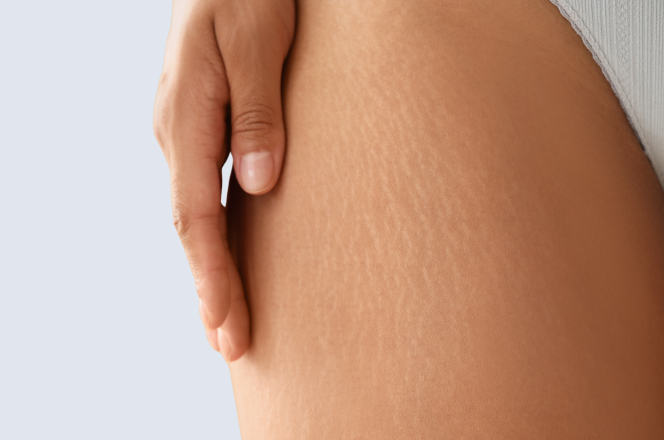2 strækmærker Strækmærker på lår og hofter kan behandles. Book tid hos O'Skin Clinic i Kolding.