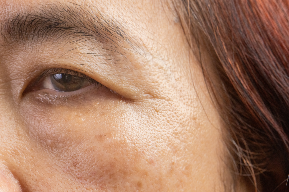 3 pigment pletter brune Pigmentpletter og pigmentforandringer kan opstå omkring overgangsalderen, fordi nogle typer pigmentforandringer er udløst af hormonelle forandringer. Pigmentpletterne kan behandles hos O'Skin Clinic.