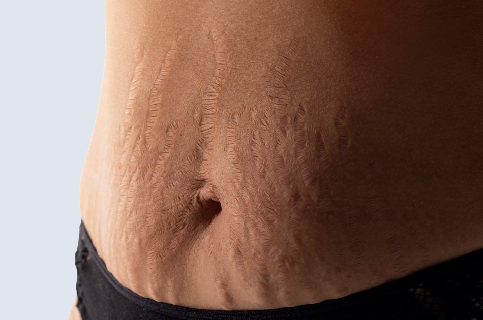 6 strækmærker Strækmærker på maven kan behandles og reduceres hos O'Skin Clinic i Kolding