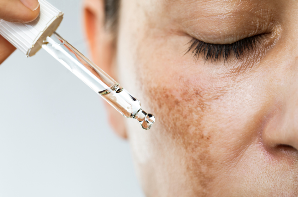 7 pigmentpletter på kind Pigmentpletter, pigmentforandringer, melasma, solpletter, alderspletter. Kært barn har mange navne, men fælles for dem er, at pigmentforandringer kan behandles hos O'Skin Clinic i Kolding.
