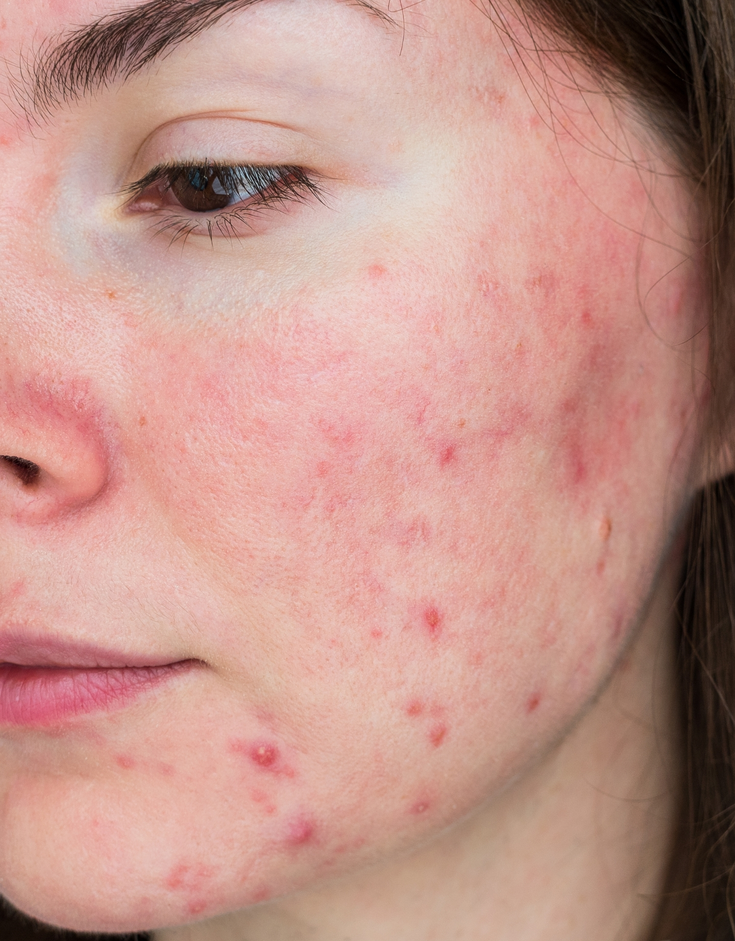 rosacea papler pustler rosacea papler pustler